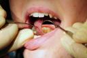 Hundreds of admissions for tooth extractions on children